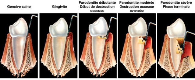parodontite_L